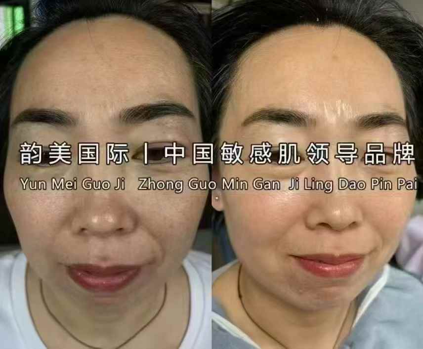 黑色素清零   |  顽固斑淡化95%  
原相机直出：色斑面积淡化80～90%-朋友圈文案论坛-朋友圈文案-云上韵美