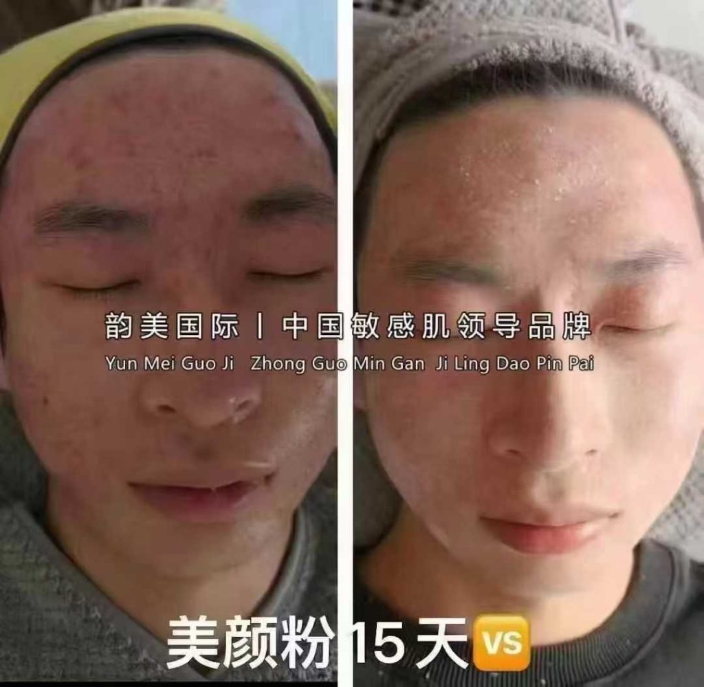 【美颜粉】-激素脸的克星✨💫💫💫
脓包痘、长年闭口粉刺都不用针清㊙
重度汗管瘤、扁平疣统统轻松搞定✨
皮炎，皮癣，牛皮癣，消杀36种病毒🦠
孕妇、婴儿都可以用的产品💐💐💐-朋友圈文案论坛-朋友圈文案-云上韵美